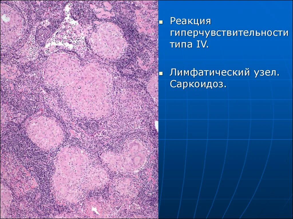 Саркоидная гранулема. Саркоидная гранулема гистология. Патоморфология саркоидоза. Саркоидоз лимфатических узлов патанатомия. Саркоидоз патологическая анатомия.