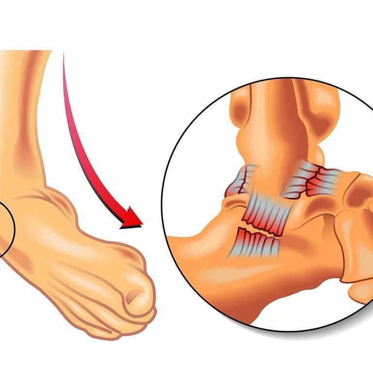 Трещина симптомы лечение. Растяжение сухожилия голеностопа. Растяжение, вывих голеностопа симптомы. Порванные связки голеностопа.