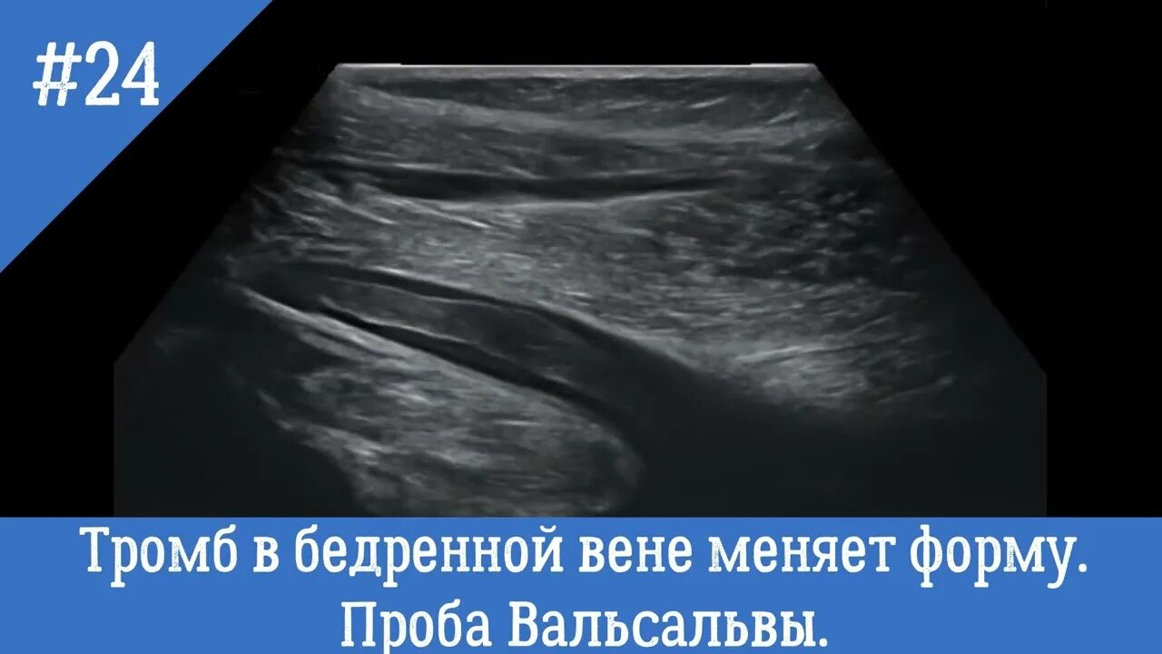 Тромбофлебит нижних конечностей на УЗИ. Флотирующий тромб по УЗИ. Узи вен тромбоз