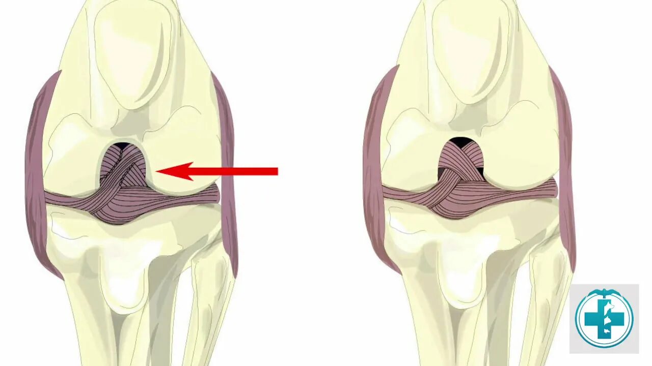 Разрыв связки у собаки. Повреждения передней крестовидной связки у собаки. Передняя крестообразная связка у собак.