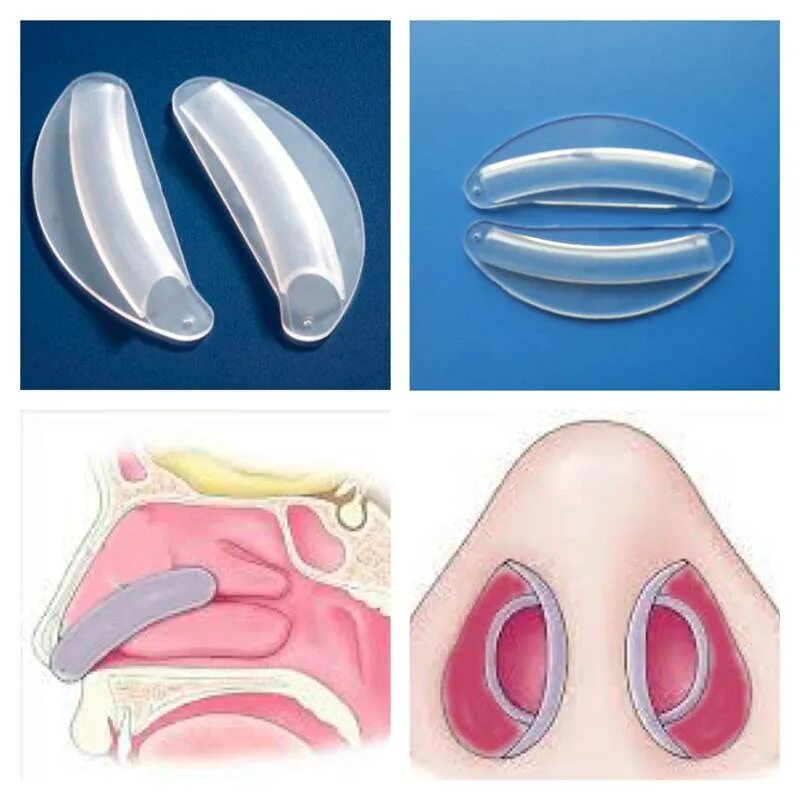 Носа навела. Сплинты для септопластики. Септопластика силиконовые сплинты. Септопластика носовой перегородки операция. Сплинты Дойля.