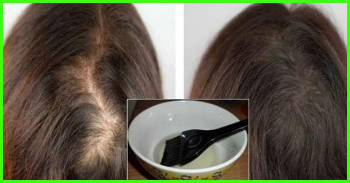 Норма выпадения волос у женщин. Выпадение волос до и после. Средняя густота волос.