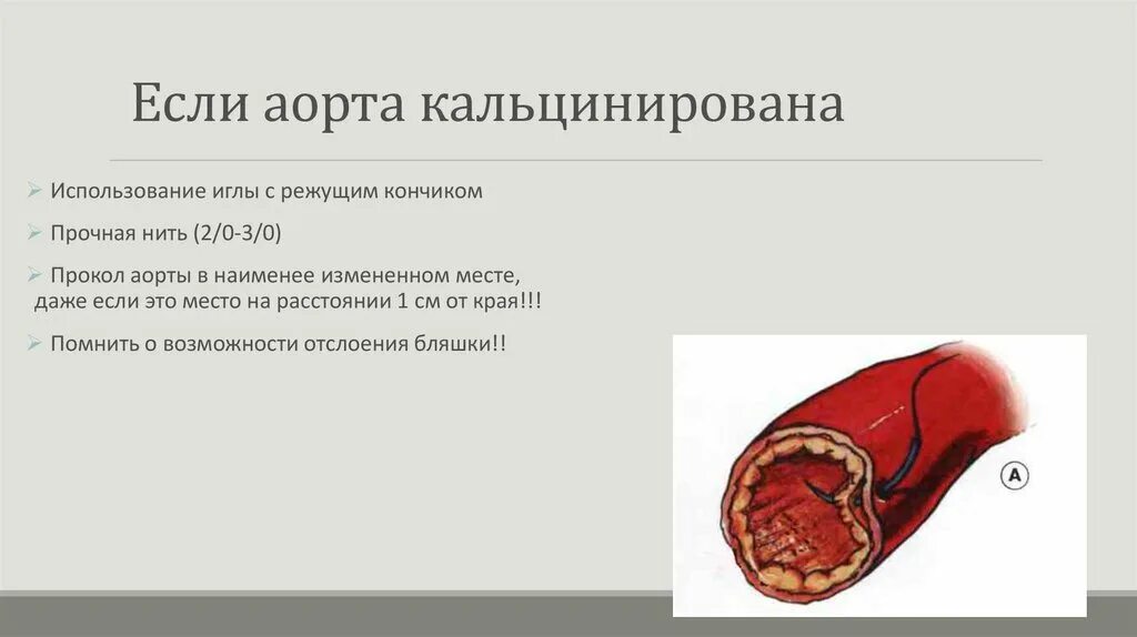 Кальциноз брюшного отдела