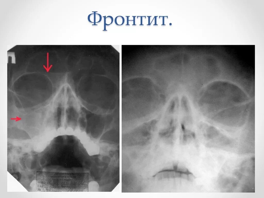 Рентген пазух носа фронтит. Рентген придаточных пазух носа синусит. Рентген околоносовых пазух гайморит.