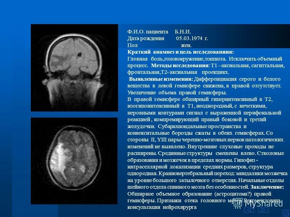 Умеренно расширение конвекситальных пространств