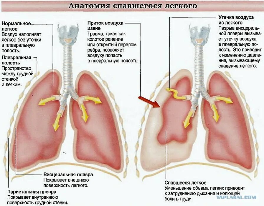 Скапливается воздух в легких. Почему уменьшается легкое