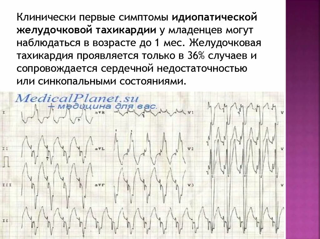 Тахикардия у ребенка 10 лет. Синусовая тахикардия у новорожденного. причины синусовой тахикардии у новорожденных. идиопатическая желудочковая тахикардия. пароксизмальная тахикардия у новорожденного.