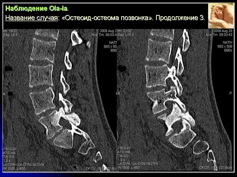 Остеома позвоночника кт. Остеома костей черепа кт. Остеома позвонка рентген. Остеоид остеома позвонка. Остеома позвоночника кт.