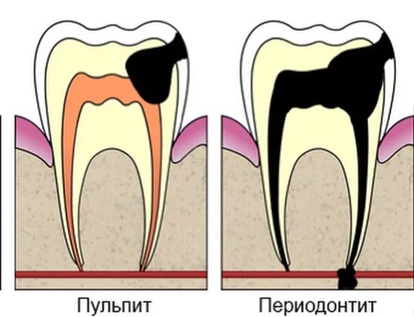 Пульпит развивается. Кариес пульпит периодонтит. периодонтит и пульпит разница. глубокий кариес пульпит периодонтит.