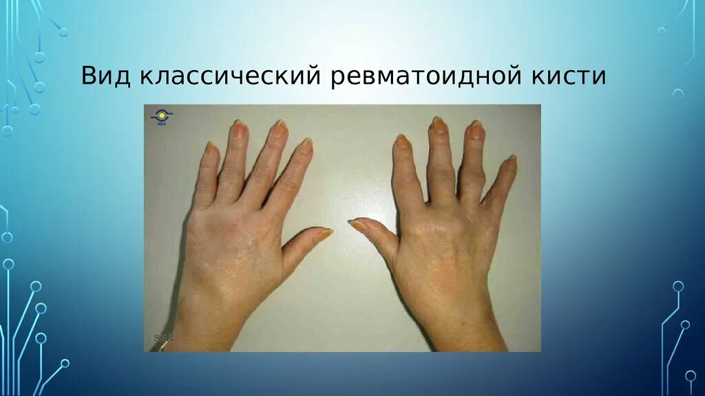 Деформации кисти при артритах. Ульнарная девиация кисти ревматоидный артрит. деформация кистей при ревматоидном артрите. деформация кисти по типу лорнетки.