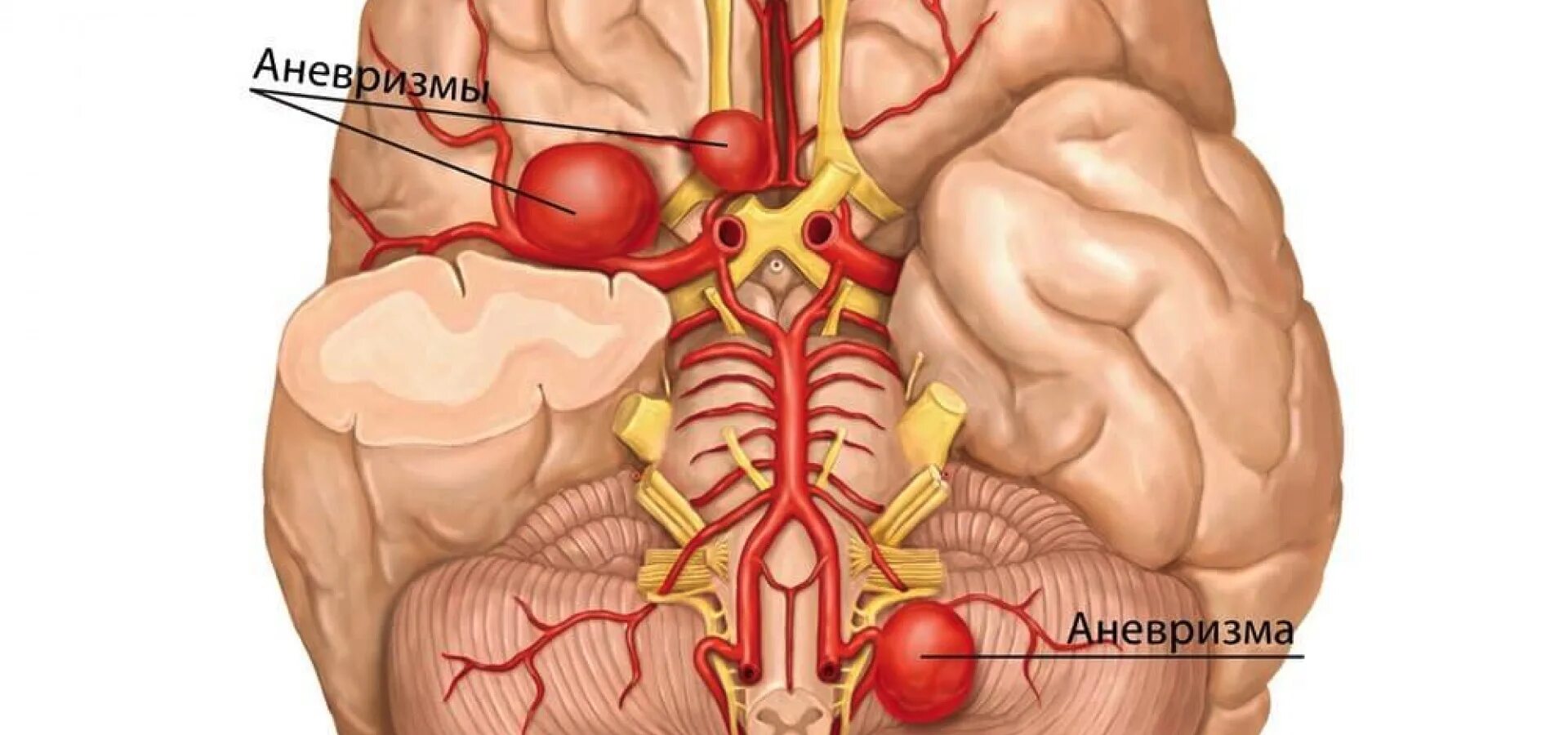 Аневризма сосудов головного мозга. Аневризма головного мозга симптомы. Микроаневризма сосудов головного мозга симптомы. Аневризма сосудов мозга. Расширение сосудов головы