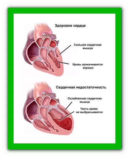 Сердечная кашель симптомы причины лечение. Сердечная кашель симптомы причины лечение