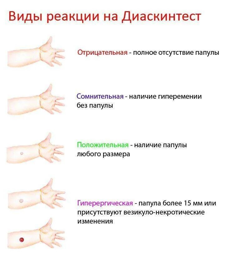 Диаскинтест что это. Оценка результатов диаскинтест норма. Манту-диаскинтест норма у детей. Прививка диаскинтест норма. Диаскин тест реакция у детей.