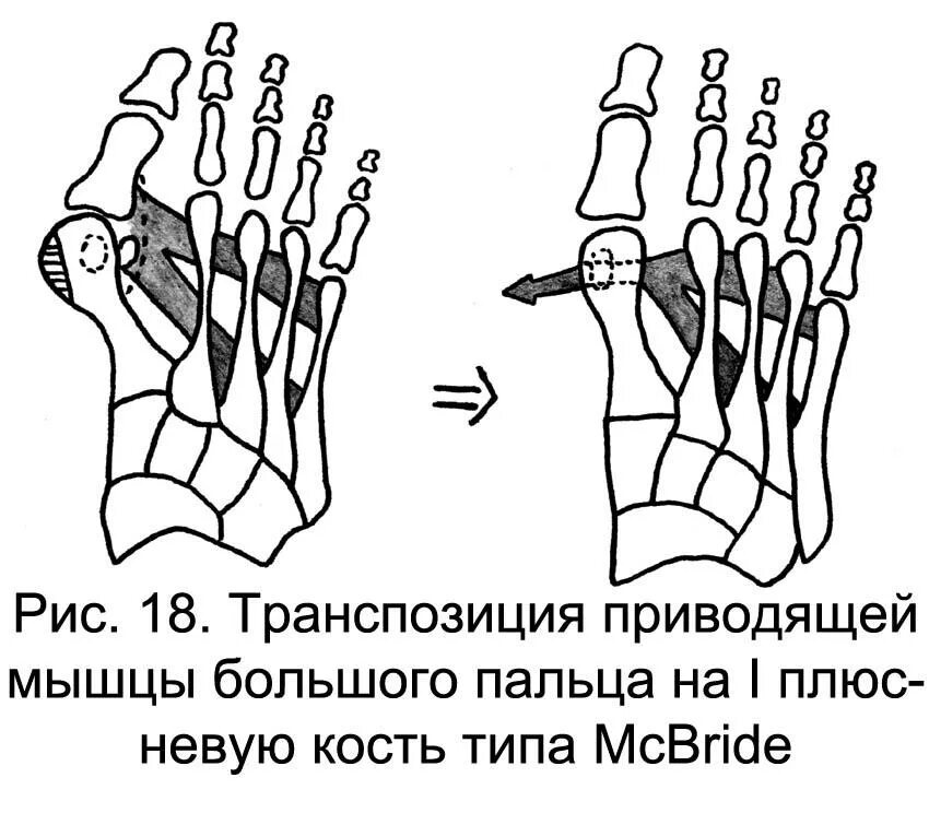 МАКБРАЙДА операция МАКБРАЙДА. Операция МАКБРАЙДА при hallux. Операция МАКБРАЙДА при hallux valgus. Операция шеде-Мак Брайда. Отводящий большой палец стопы