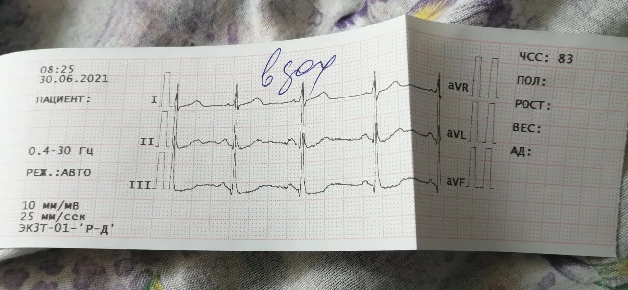 Преобладание потенциалов лж на ЭКГ что. Преобладание потенциалов левого желудочка на ЭКГ. Преобладание потенциалов лж на ЭКГ У детей. На ЭКГ здорового новорожденного ребенка преобладают потенциалы. Экг преобладание левого желудочка