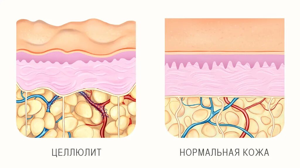 Распад кожи. Подкожно-жировая клетчатка целлюлит. Целлюлит воспаление подкожно-жировой. Целлюлит воспаление ПЖК. Целлюлит гистология.