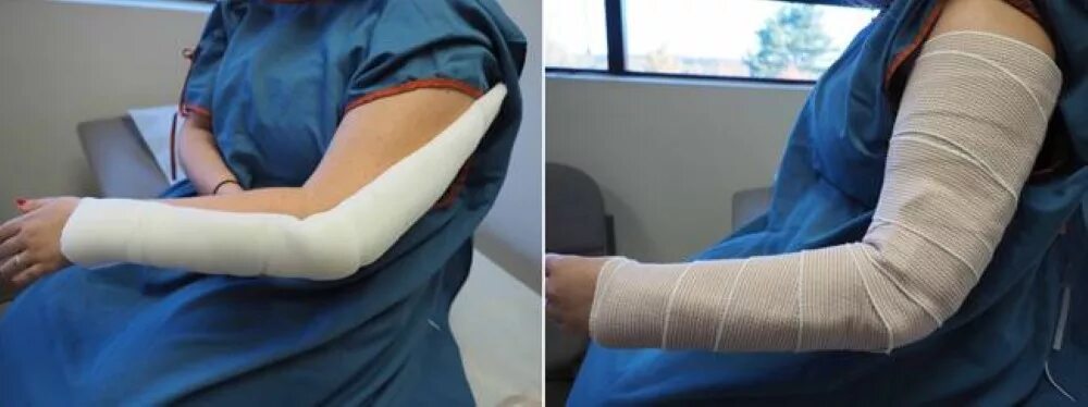 Отекает рука в гипсе при переломе