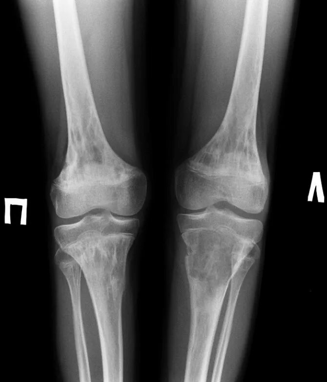 Саркома Юинга плечевой кости рентген. Саркома коленного сустава рентген. Саркома Юинга берцовой кости. Артроз коленного сустава название