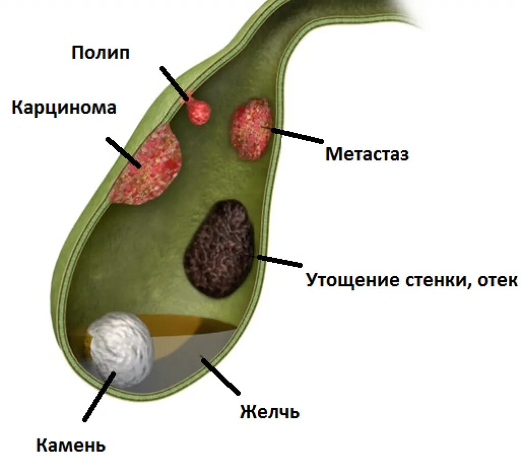 Народное лечение полипа в желчном пузыре. Полипоз желчного пузыря. Полип стенки желчного пузыря. Полип на желчном пузыре желчный.