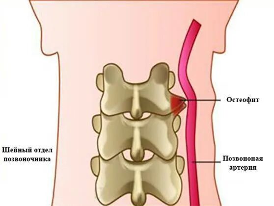 Пояснично-крестцовый остеохондроз. Симптомы остеофитов позвоночника. Краевые остеофиты тел позвонков l1-l5. Краевые костные разрастания тел позвонков шейного отдела. Остеофиты позвоночника в l4.
