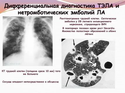 Очаг в грудине