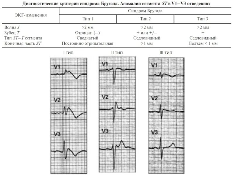 Диагностические ЭКГ критерии синдрома Бругада. Синдром Бругада клинические рекомендации на ЭКГ. ЭКГ-критерии синдрома Бругада 3 типа. Синдром Бругада Тип 1 2. Экг метаболические изменения что это значит
