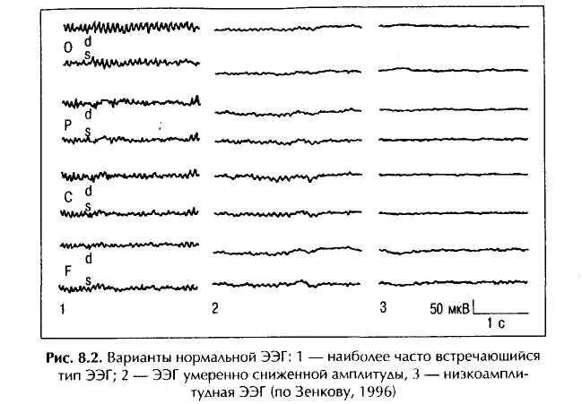 Низкоамплитудная ээг. Десинхронный Тип ЭЭГ это норма. Плоский Тип ЭЭГ. Плоский Тип ЭЭГ Кривой. ЭЭГ десинхронизированного типа.