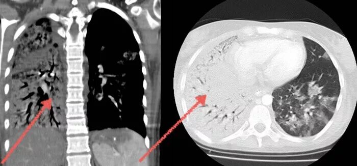 Ковид пневмония кт. Компьютерная томография грудной клетки пневмония. Ковидная пневмония на кт. Пневмония при Ковиде на кт.