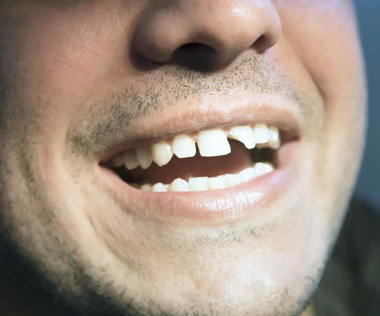 выбивают клыки. выбивают клыки. выбивают клыки. выбивают клыки. грилзы бриллиантовые.