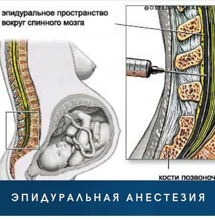 Спинальная анестезия позвонок. Спинальная и эпидуральная анестезия. Эпидуральная анестезия в грудном отделе позвоночника. ЭТКН+эпидуральная анестезия.