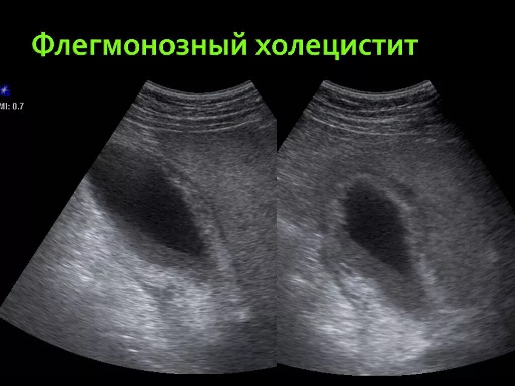 Острый гангренозный калькулезный. Узи желчного пузыря калькулезный холецистит. Острый калькулезный холецистит классификация. Острый гангренозный калькулезный. Жкб хронический калькулезный холецистит.