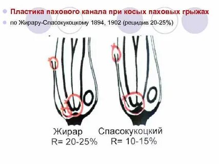 Операция пахового канала