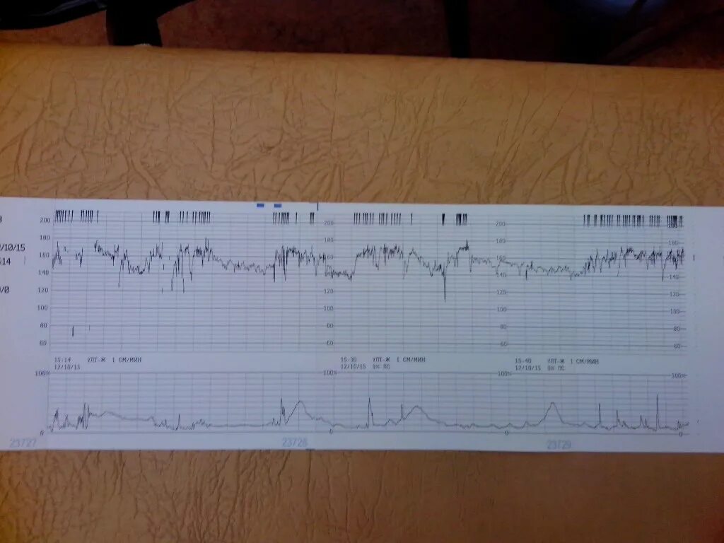 КТГ на 40 неделе беременности норма. Норма сердцебиения на КТГ В 40 недель. КТГ при беременности норма 40 недель. КТГ 40 недель нормы. Схватки на 36 неделе