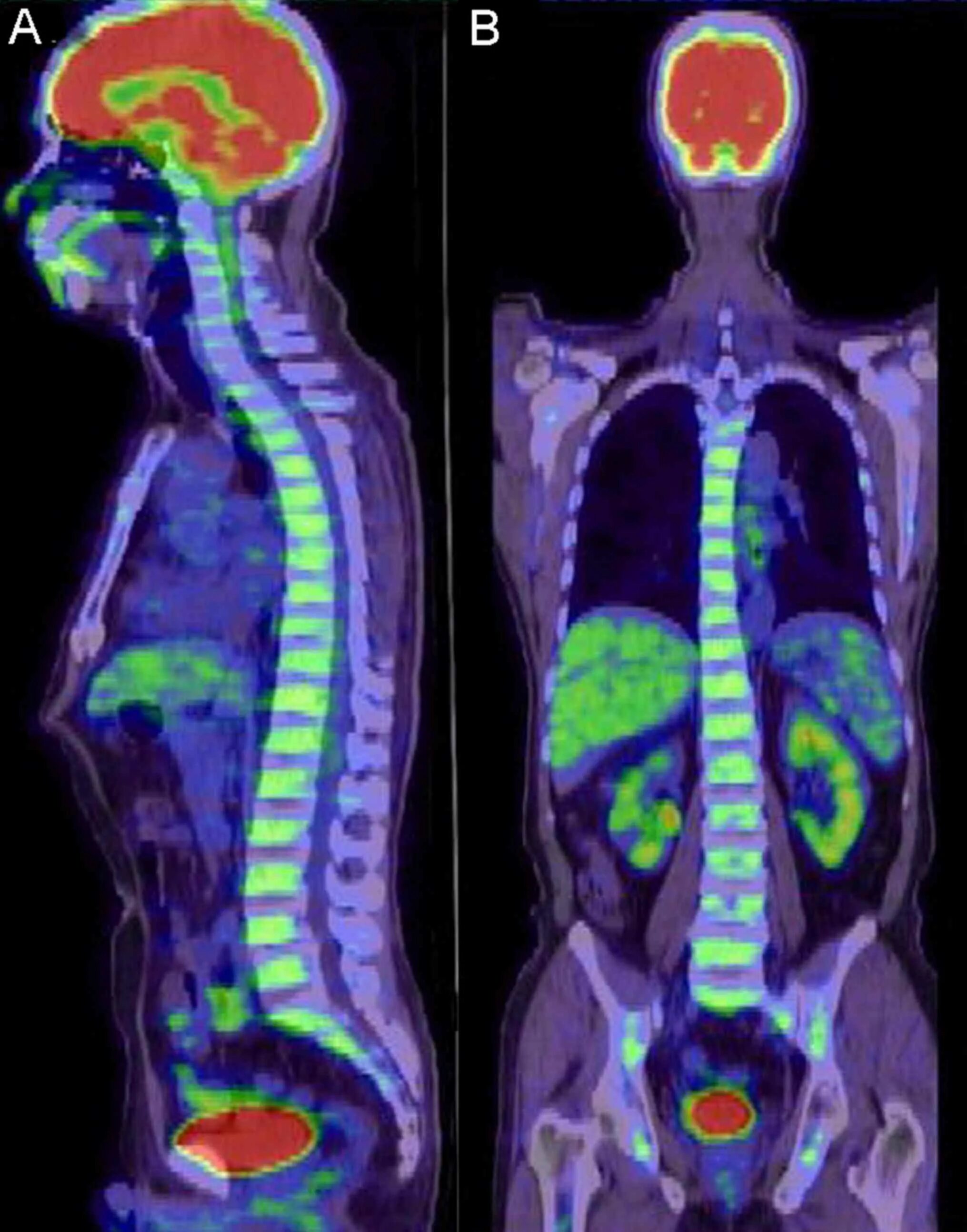 Pet ct. Позитрон-эмиссионная томография. Позитронно-эмиссионная кт. Позитрон эмиссионная томография ПЭТ-кт. Позитронно эмиссионная томография Позитрон.