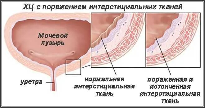 Цистит интерстициальный симптомы у женщин и лечение. Интерстициальная ткань. Интерстиция это ткань.