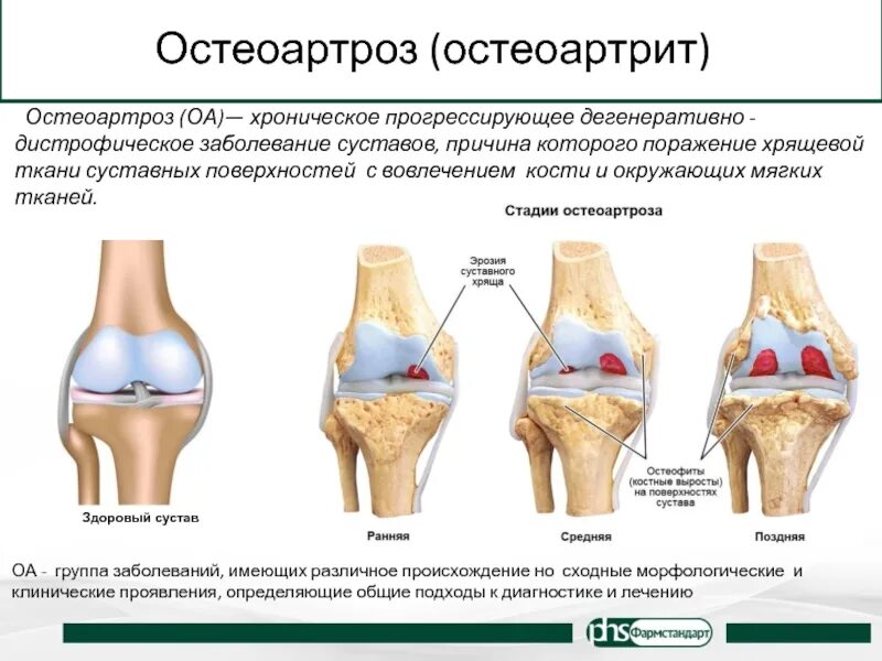 Диагноз доа суставов. Деформирующий остеоартроз поражение суставов. Остеоартрит (артроз, дегенеративные заболевания суставов). Деформирующий артроз коленного сустава классификация. Гонартроз коленного сустава патогенез.