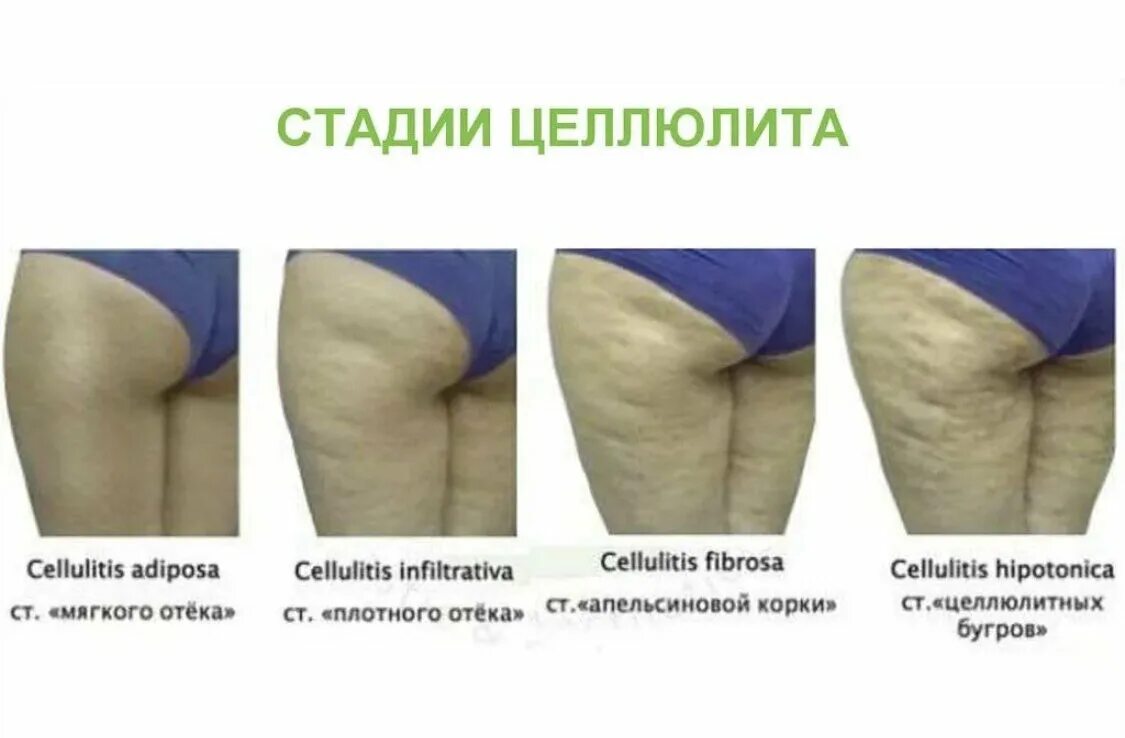 Почему появляется целлюлит. Целлюлит воспаление подкожно-жировой.