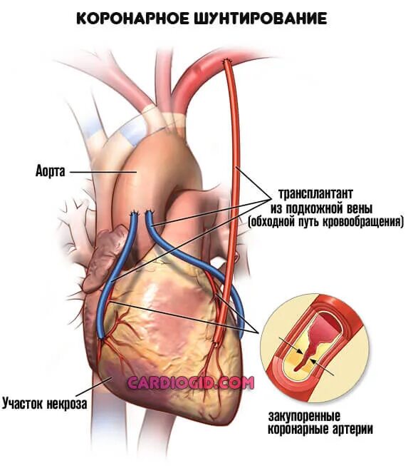 Трансплантант. Шунтирование коронарных артерий. Коронарное шунтирование сосудов. Схема операции аортокоронарного шунтирования. Операция шунтирование сосудов сердца.