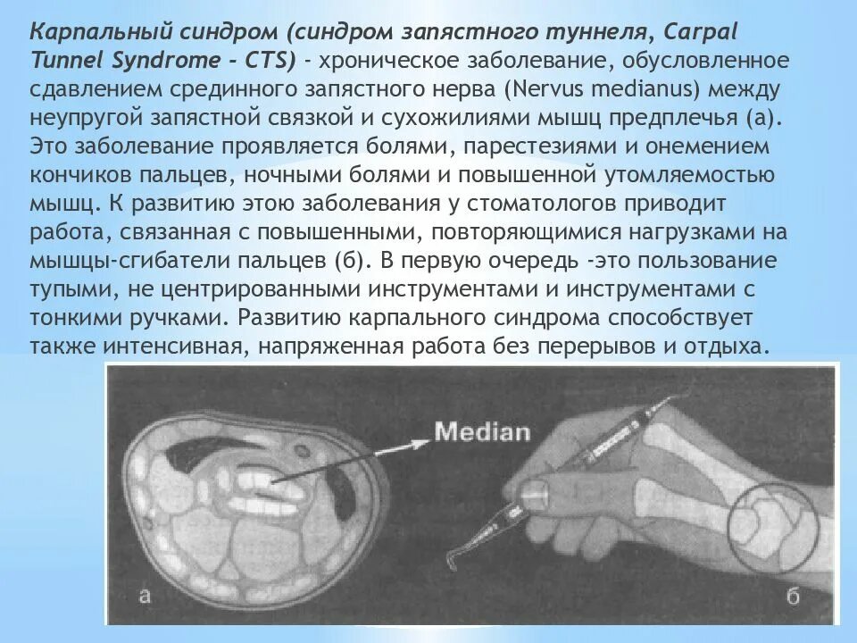 Карпальный запястном синдроме. Карпальный запястном синдроме