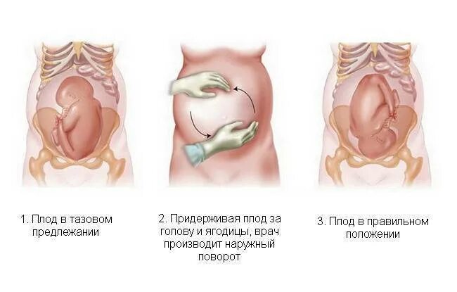 Тазовое предлежание плода кесарево. Наружный поворот плода на головку при тазовом предлежании. Внешний акушерский переворот плода. Кесарево сечение при головном предлежании. Акушерский поворот плода при тазовом предлежании при родах.