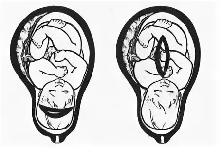 Возможно ли родить с