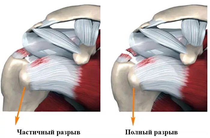 Частичный разрыв сухожилия. Ротаторная манжета плечевого сустава анатомия. Ротаторная манжета плечевого сустава разрыв. Ротаторная манжета плеча тендинит. Тендинит ротаторной манжеты плечевого сустава.