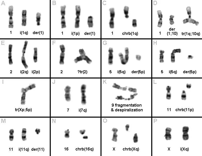 Дицентрические хромосомы болезни. Изохромосомия заболевания. Изохромосомия примеры болезней. Как обозначается изохромосома.