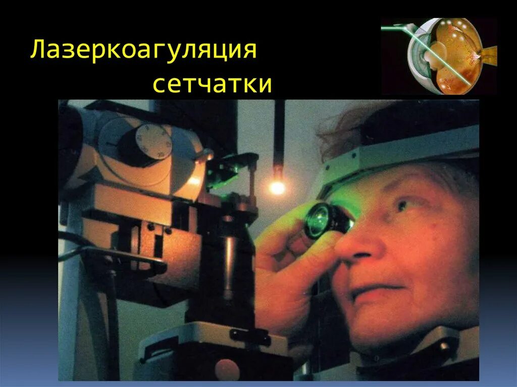 Фокальная лазерная коагуляция глазного дна. Фокальная лазерная коагуляция сетчатки глаза. Аппарат для лазерной коагуляции сетчатки. Припаивание сетчатки глаза лазером.