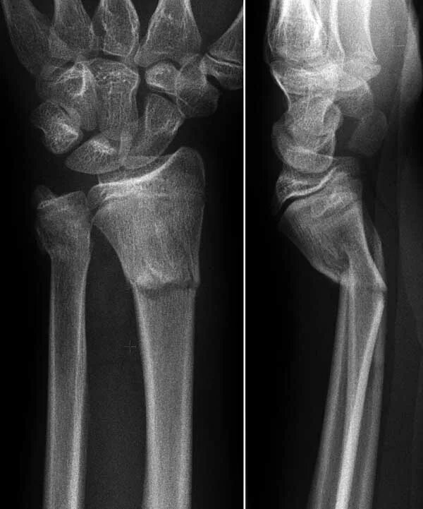 дистальный метаэпифиз локтевой кости