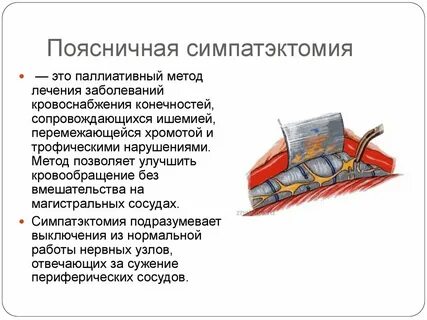 Симпатэктомия