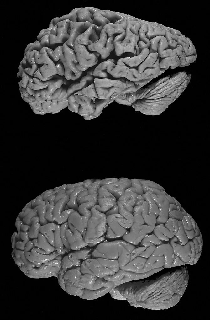 Brain old. Болезнь Альцгеймера мозг. Мозг больного Альцгеймером.