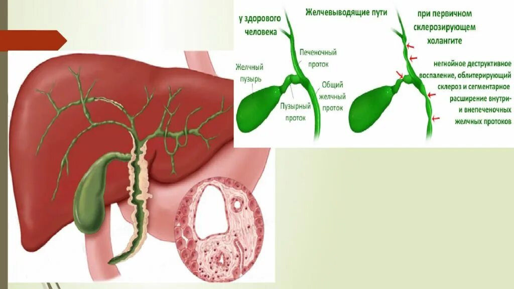 Желчно выводящие пути. Закупорку желчных печеночных протоков. Желчный пузырь закупорка желчных протоков. Закупоривание желчных протоков симптомы. Закупорка общего желчного протока.