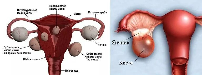 Как выглядит яичник. Матка киста киста яичники.