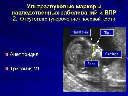 Аплазия носовой кости